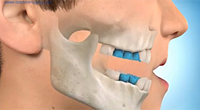Ortodontik Yüz Maskesi